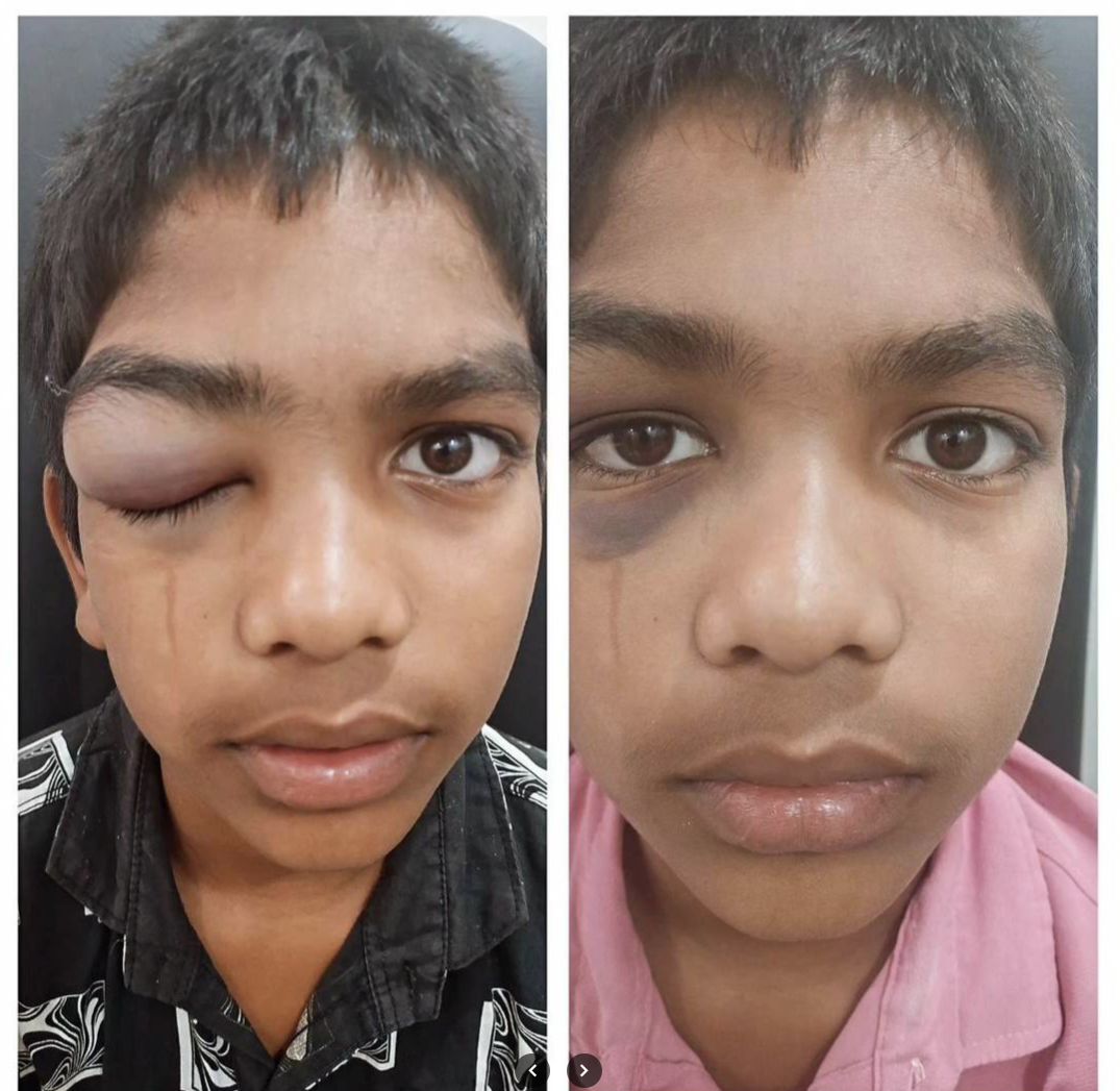 Before and after recovery from an eye injury